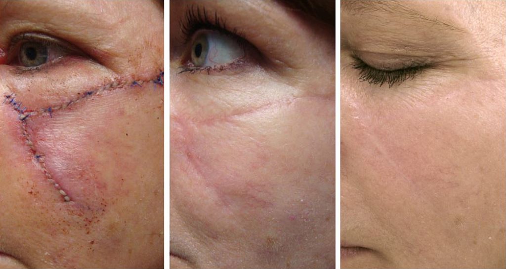 Facial trauma scar showing progression from initial injury through healing to final improved result
