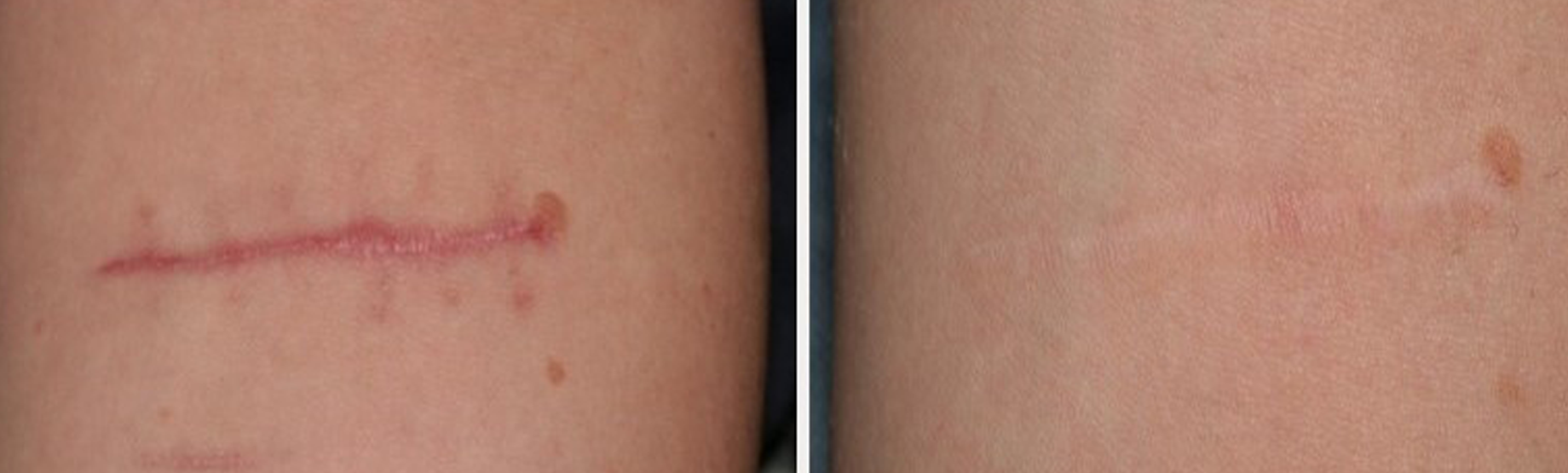 Post-surgical scar showing significant improvement after laser treatment